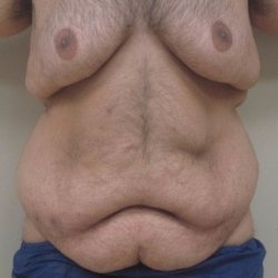 Manhattan abdominoplasty before 15